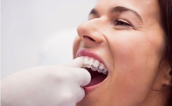 antalya telsiz-ortodonti-invisalign